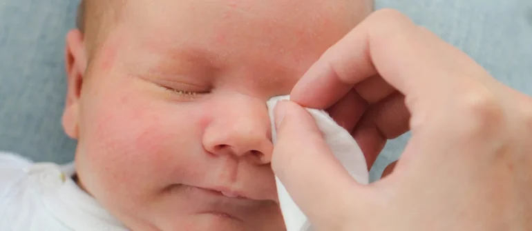 Bebeklerde Göz Çapaklanması